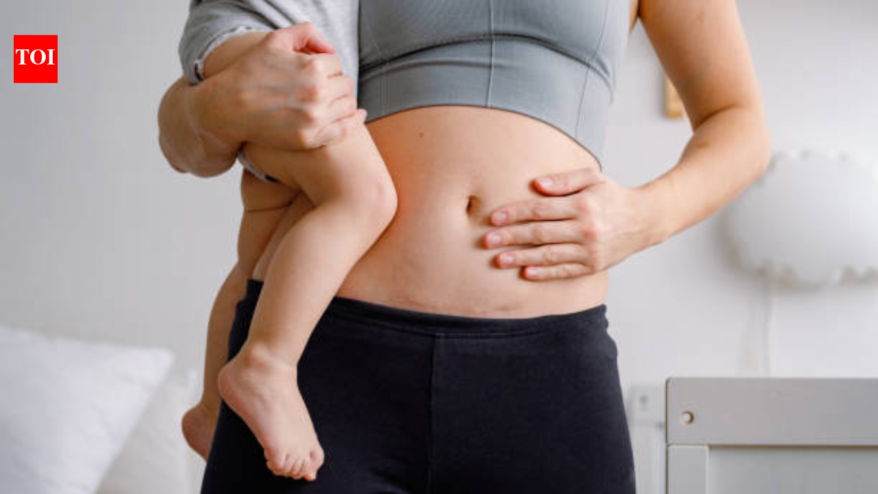 Caesarean section myths debunked: What every expecting parent needs to know