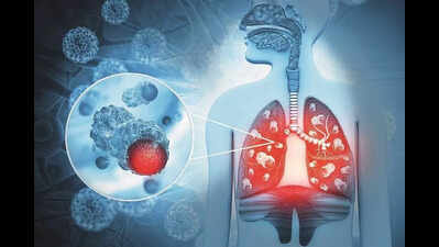 Multi-drug resistant TB cases down 28% in 3 yrs, frontline workers say testing low