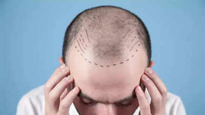 Days after TN order, doctors seek similar rules nationwide as hair transplant boom raises safety alarm