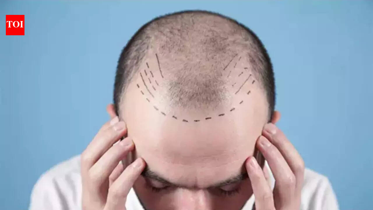 Days after TN order, doctors seek similar rules nationwide as hair transplant boom raises safety alarm
