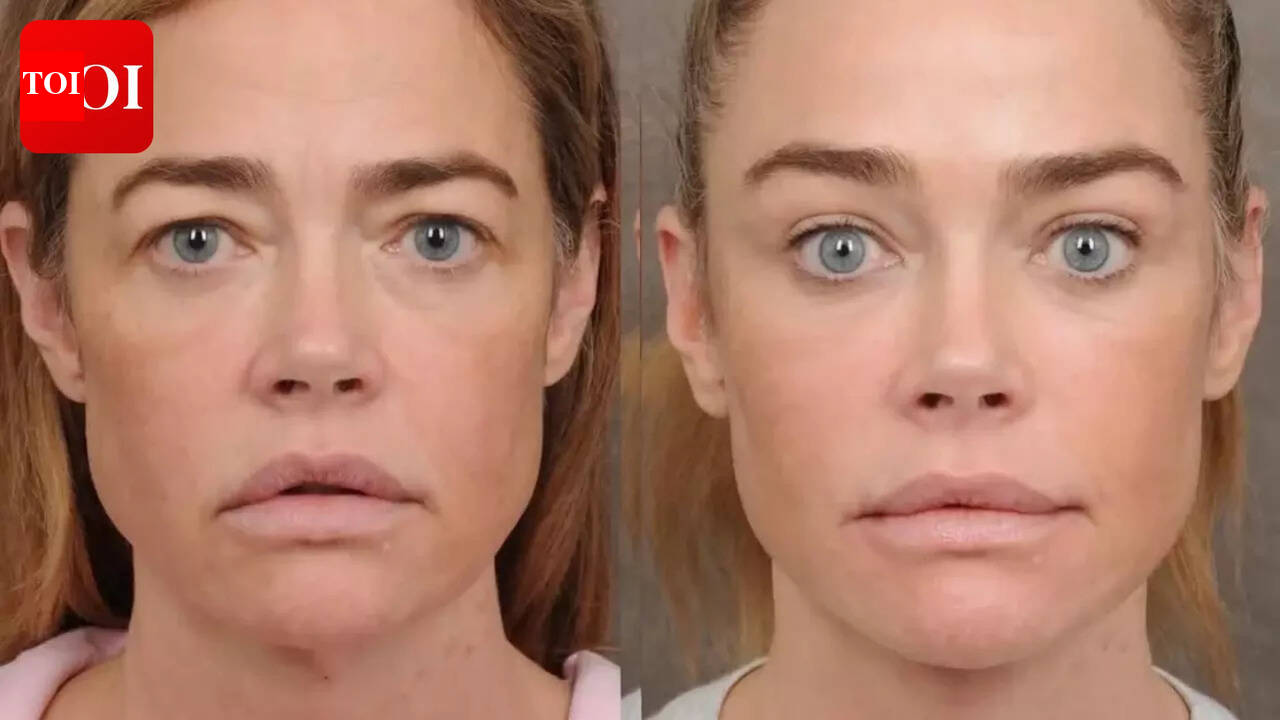 Denise Richards opens up about facelift; surgeon hails actress for bravely sharing 'before and after' pics