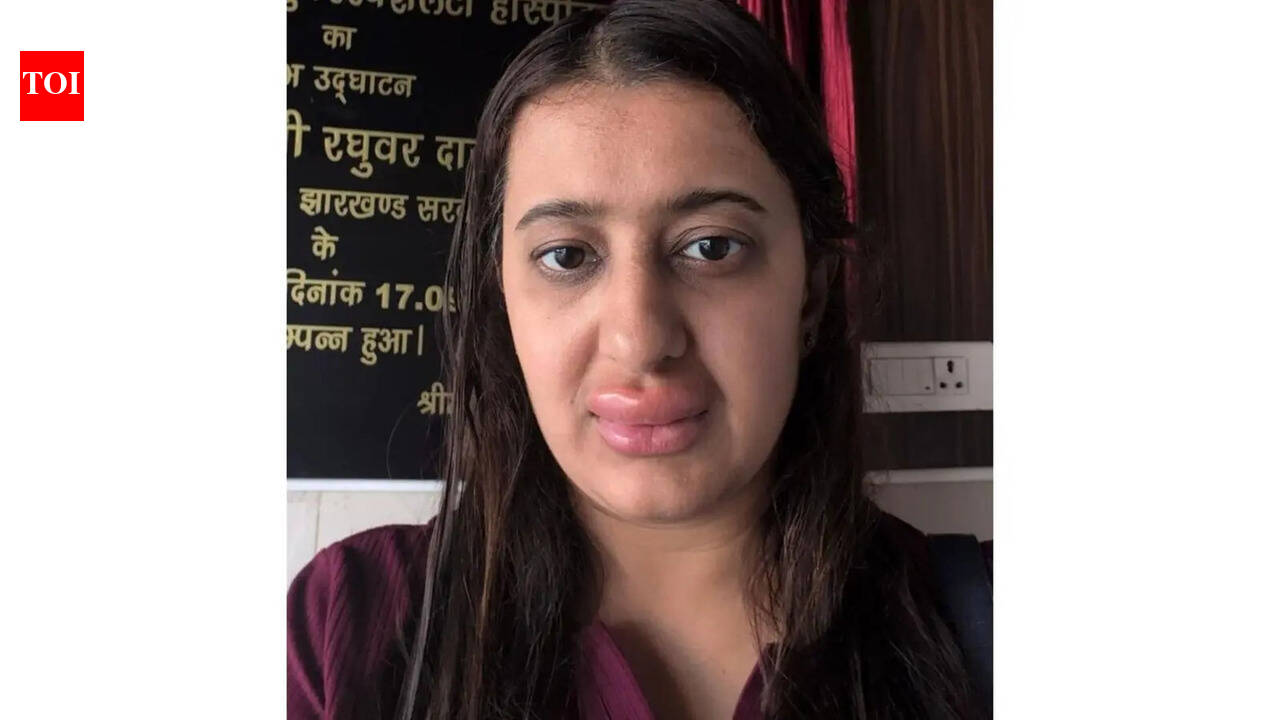 Woman reports severe allergy after consuming meal on Vande Bharat Express; IRCTC says ‘lunch on train was…’