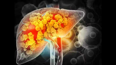 Diabetes emerges as a major driver of advanced liver disease in India