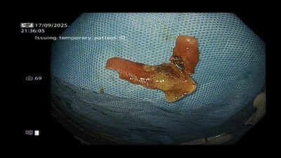 Laser saves man after denture gets stuck in food pipe