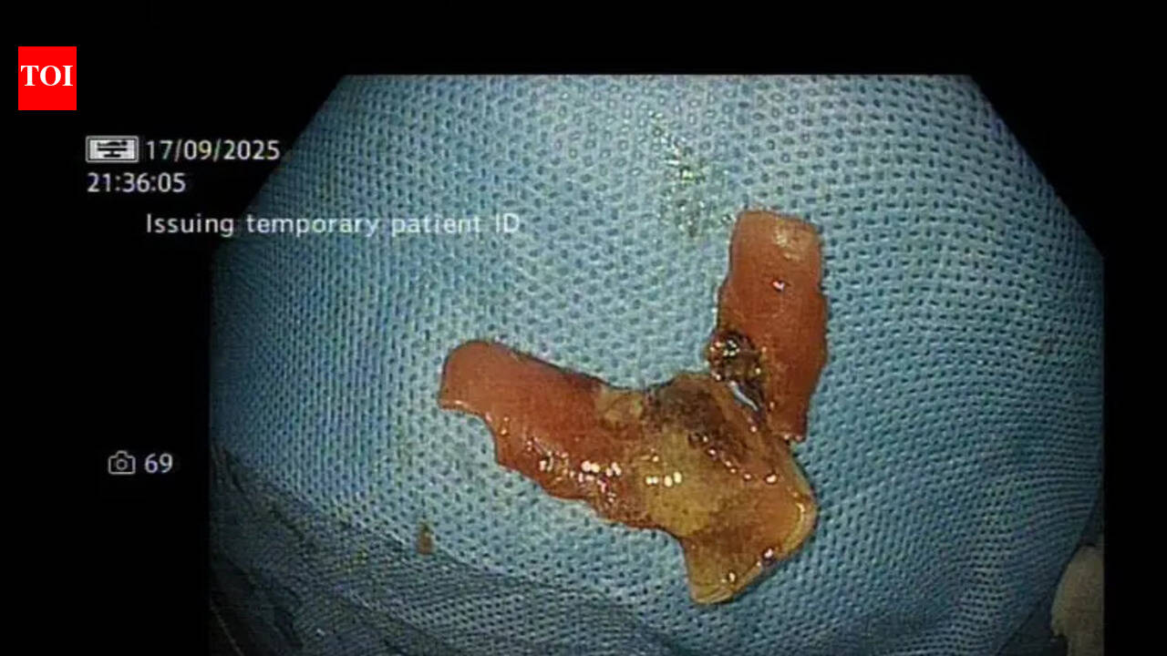 भोजन नली में डेन्चर फंसने के बाद लेजर ने आदमी को बचाया | भारत समाचार