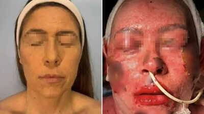Brazilian woman loses 55% of her skin after taking antidepressants: What you must know about Stevens-Johnson syndrome