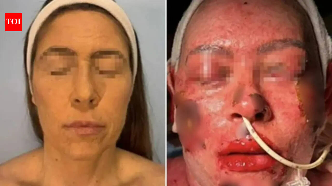 Brazilian woman loses 55% of her skin after taking antidepressants: What you must know about Stevens-Johnson syndrome