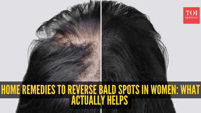 Alopecia Areata remedies: Home remedies to reverse bald spot in women