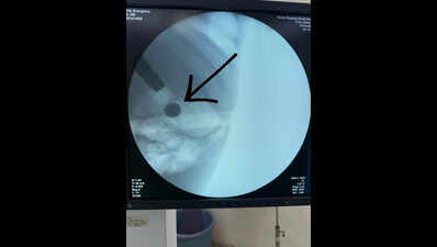 Doctors at Noida hospital save toddler who swallowed lithium battery