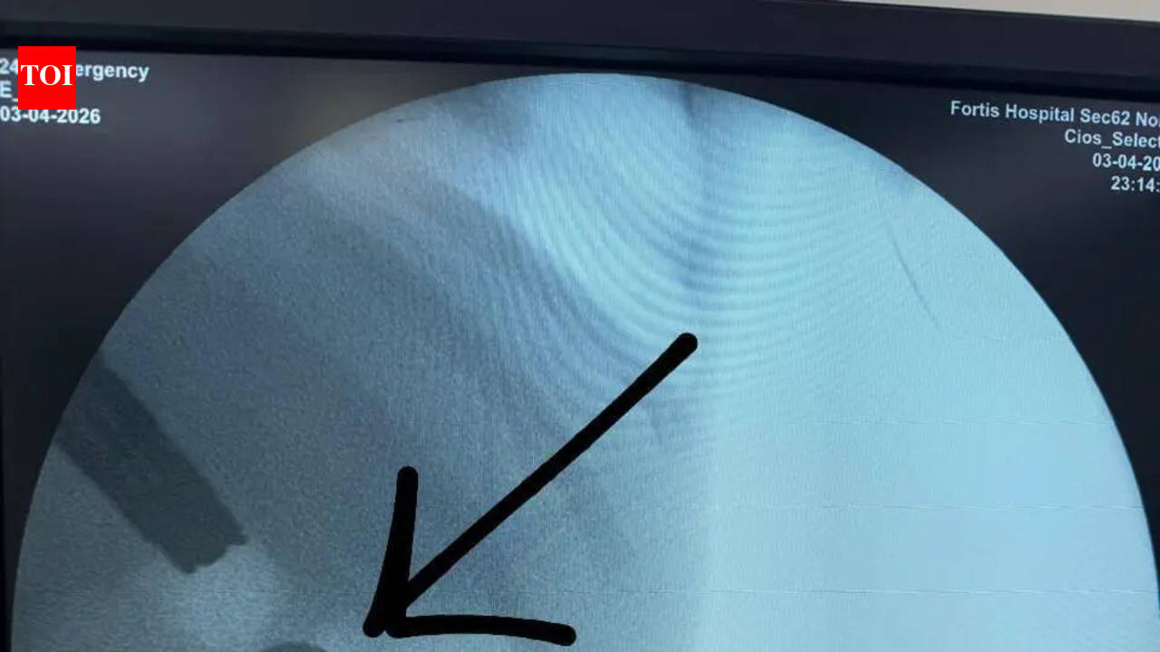 Doctors at Noida hospital save toddler who swallowed lithium battery