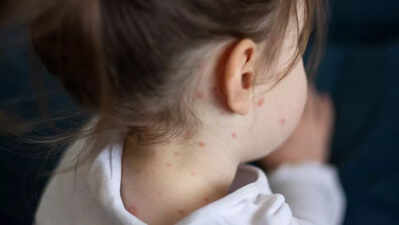 Measles case reported in Palamu