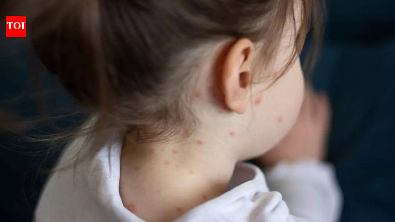 Measles case reported in Palamu