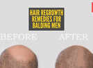 Reverse male pattern baldness: Home remedies for hair regrowth in balding men