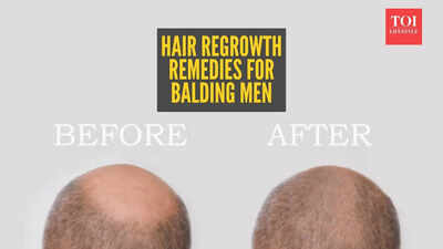  Home remedies for hair regrowth in balding men