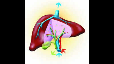 Swap transplant helps save two fatty liver patients