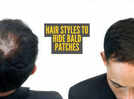 Alopecia Areata: 5 clever hairstyles to gracefully conceal bald patches