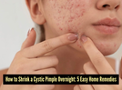 5 simple home remedies to shrink a cystic pimple overnight