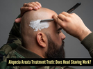 Alopecia Areata myth: Does shaving your head really help hair regrowth?