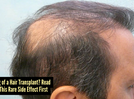 Hidden risks of hair transplants: A rare but serious side effect that no one talk about