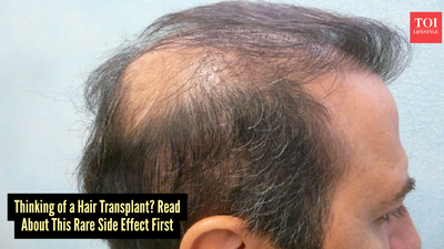 Hidden risks of hair transplants: A rare but serious side effect that no one talk about