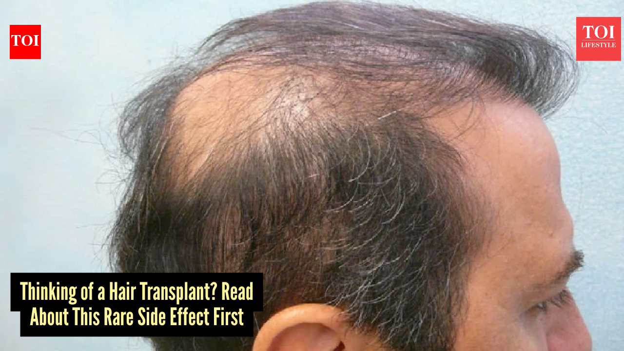 Hidden risks of hair transplants: A rare but serious side effect that no one talk about