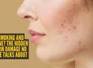 Can&rsquo;t get rid of acne? Your smoking habit might be the real culprit