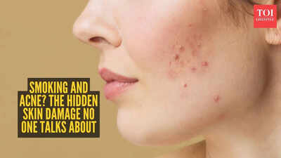 Can’t get rid of acne? Your smoking habit might be the real culprit