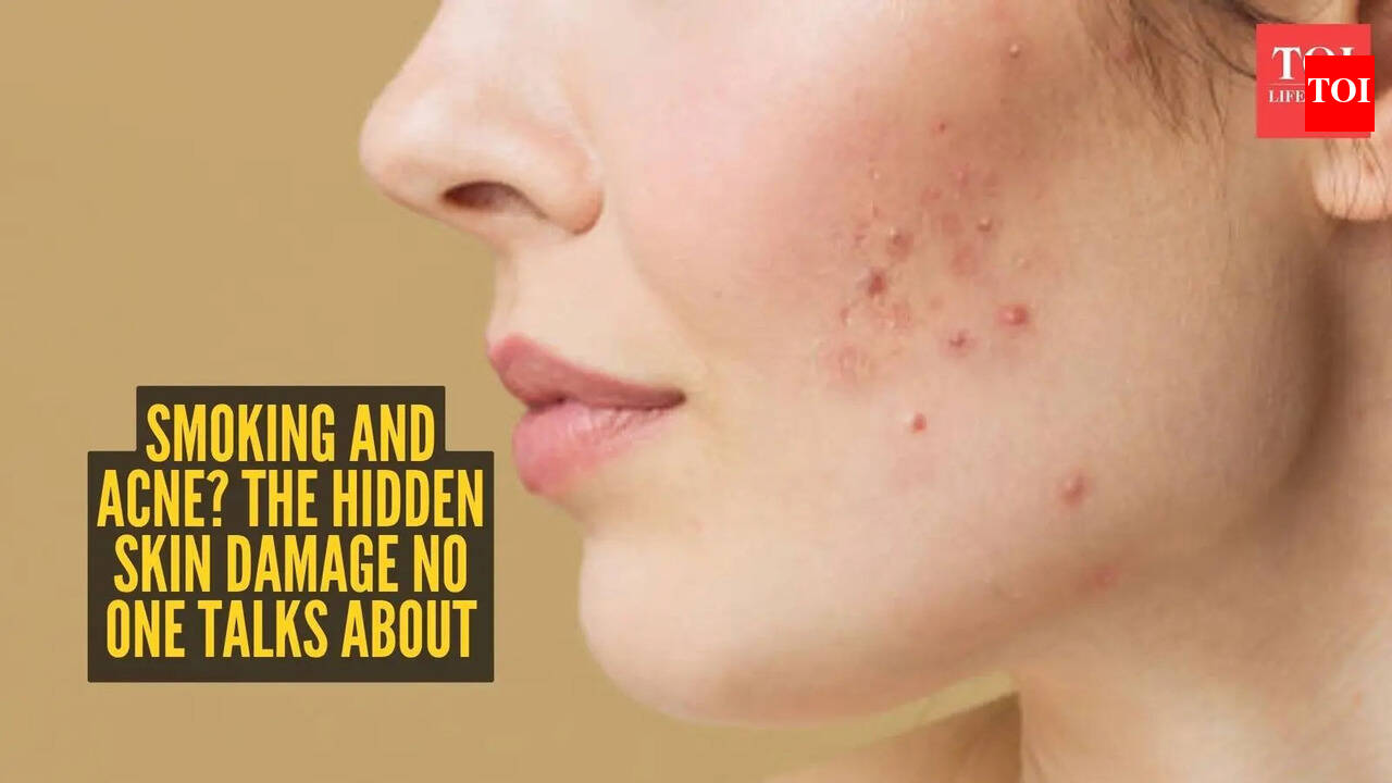 Can't get rid of acne? Your smoking habit might be the real culprit