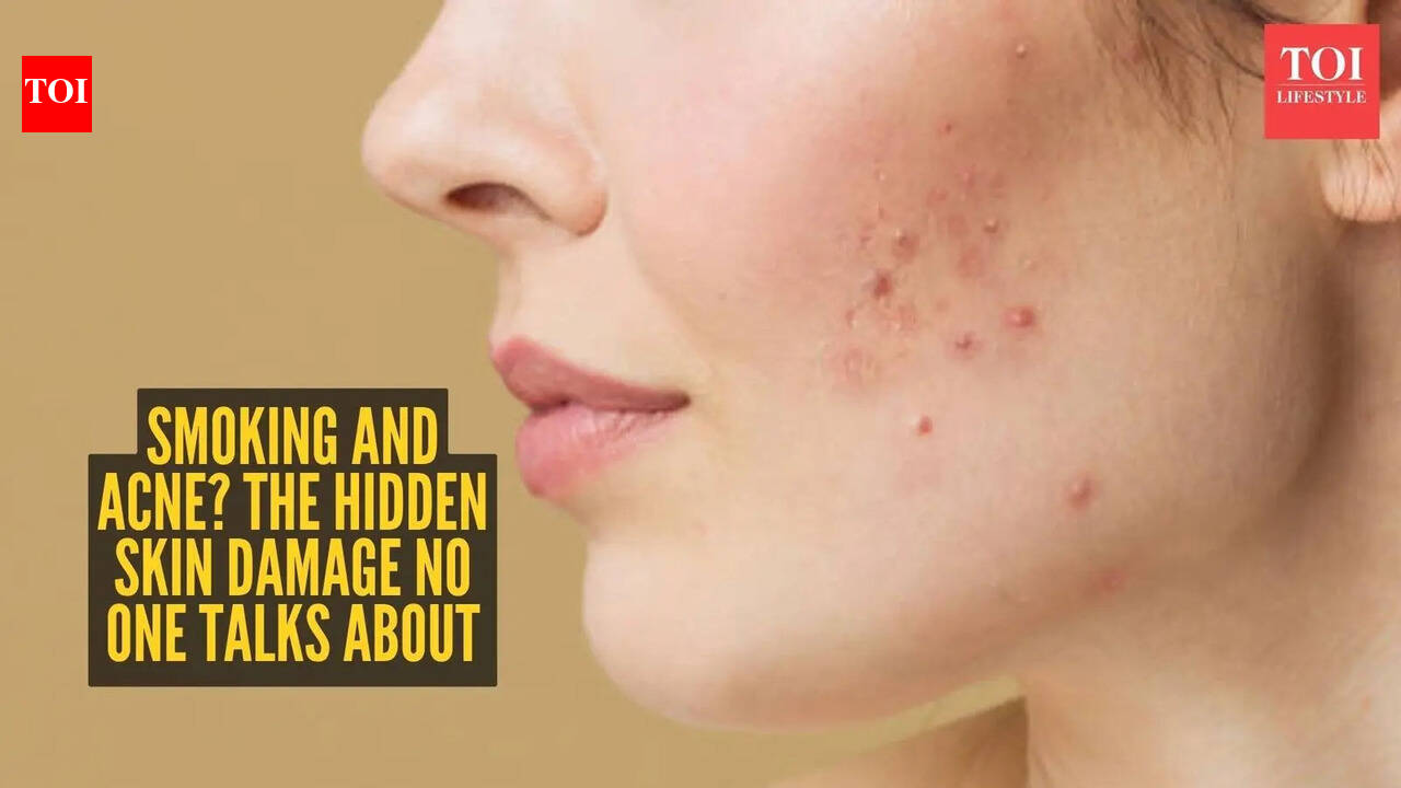 Can’t get rid of acne? Your smoking habit might be the real culprit