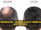 How to reverse hair loss with microneedling and rosemary oil