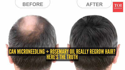 How to reverse hair loss with microneedling and rosemary oil