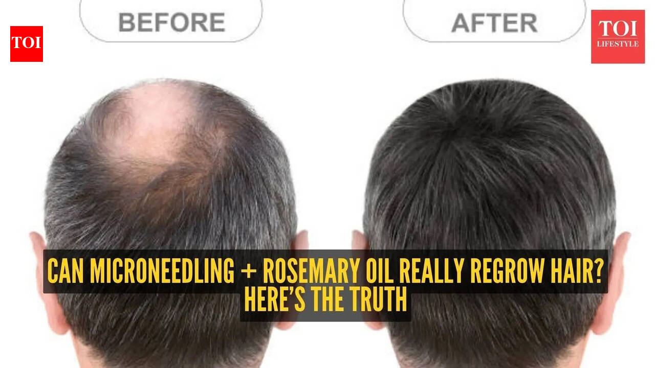 How to reverse hair loss with microneedling and rosemary oil