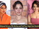 Priyanka Chopra to Shraddha Kapoor: 5 Bollywood celebrities who struggled with acne and the DIY remedies that helped them