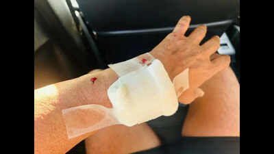 60-year-old marathon runner attacked by stray dog in Dumas