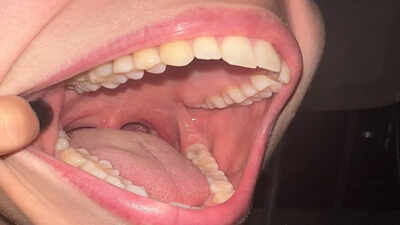 Scientists develop a regenerative therapy that may bring back teeth
