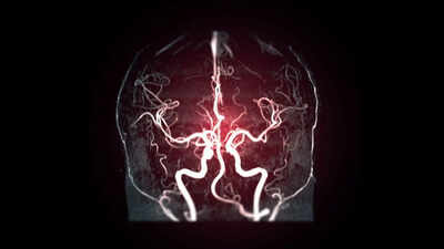 7 silent warning signs that may mean you need a Cerebral Angiography