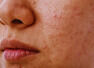 5 hidden nutritional deficiencies that trigger skin pigmentation