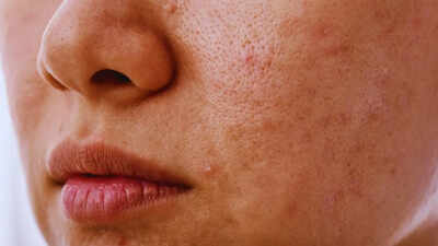 5 hidden nutritional deficiencies that trigger skin pigmentation in women