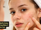 Summer acne stages: Know when it&rsquo;s the right time to visit a dermatologist
