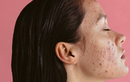 Stage 2: Severe inflammatory acne