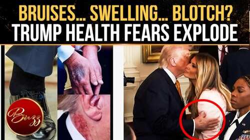 Donald Trump Health Buzz Explodes After Viral Hand Photos