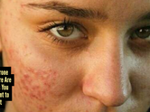 5 fruits that could be triggering your acne