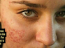 5 fruits that could be triggering your acne