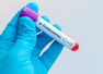Silent Thalassemia carriers: Doctor explains hidden genetic risk many Indians don&rsquo;t know about
