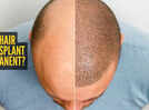 Is hair transplant permanent?