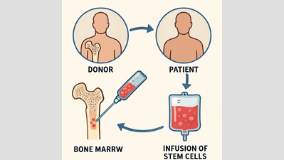 Bone marrow transplant: Mumbai’s Sion Hospitsal can handle 80 cases a year