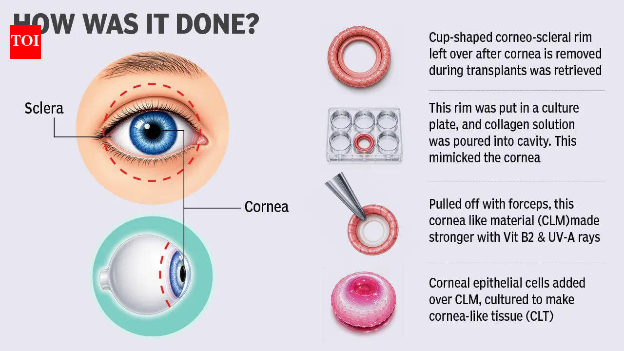 Discarded eye tissue offers hope for cornea shortage