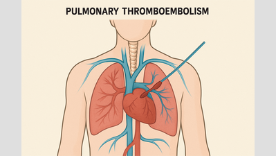 Pulmonary blood clots affect 1 in 1,000 people, but awareness of surgery remains low: Bengaluru Experts