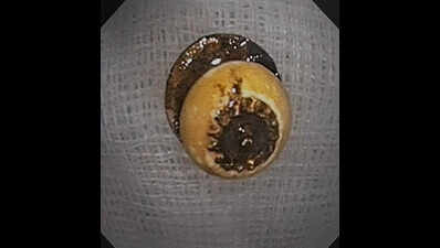 79-year-old swallows button in sleep, safe after op at city hosp
