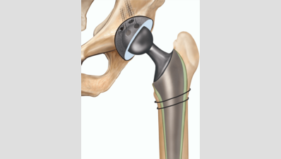 91-year-old Mumbai resident’s hip surgery highlights rise in elderly joint replacements